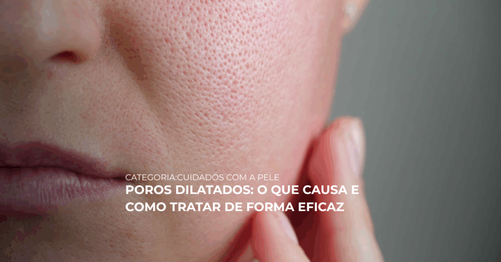 POROS DILATRADOS
